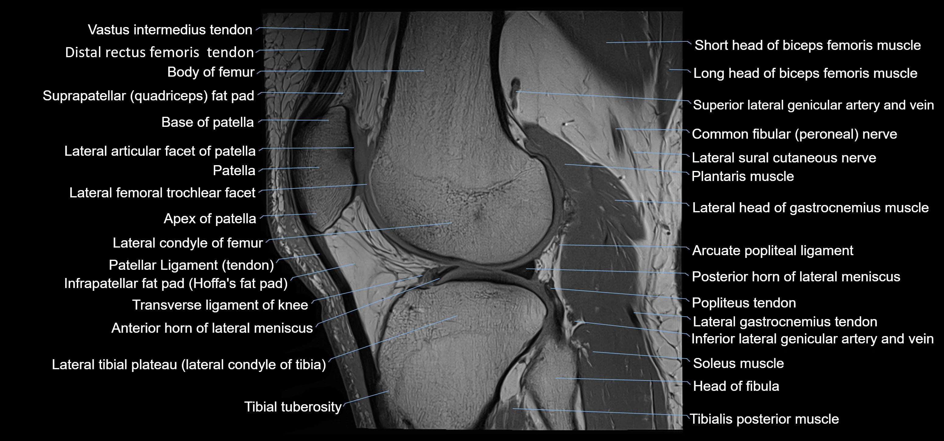 MRI knee sagittal cross sectional anatomy labelled 3T radiology image-00032.webp